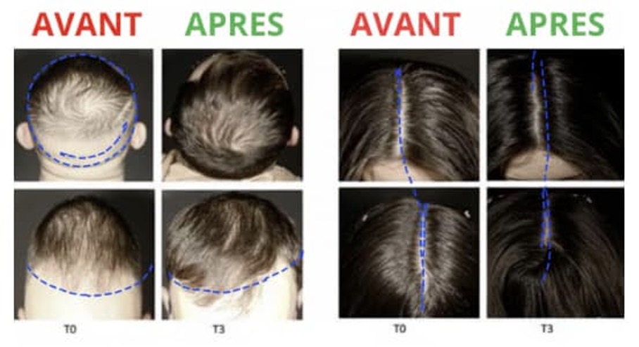 ECA Avant Après raie